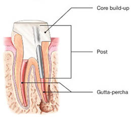 Root canal treatment in Whitefield
