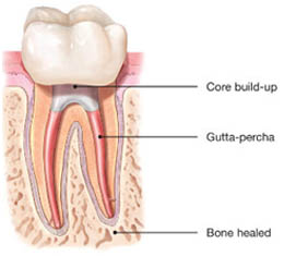 Root canal treatment in AECS layout